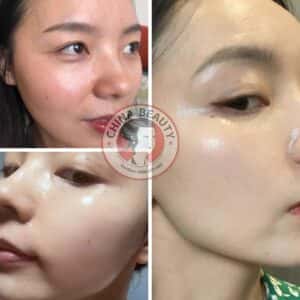Alternative view of OBLUE - LIỆU PHÁP TRUYỀN TRẮNG, GIẢM NÁM BẰNG ĐƯỜNG UỐNG CAO CẤP